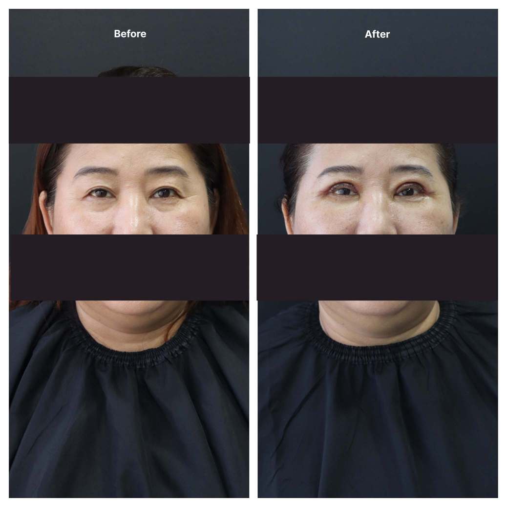 Eyelid Surgery KOQ10